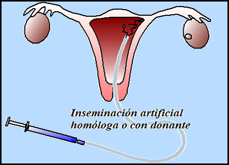 Inseminación artificial homóloga o con donante