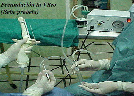 Fecundación in Vitro (Bebe probeta)